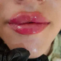 ژل و بوتاکس