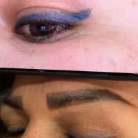 ریموو حرفه ای فقط در یک الی دو‌جلسه