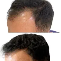 دوره نانوکیو برای پرپشتی مو