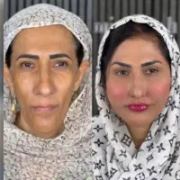 تزریق ژل لب و گونه و چانه.. (جشنواره)درمطب فقط599ت|خدمات آرایشگری و زیبایی|اصفهان, باغ زیار|دیوار