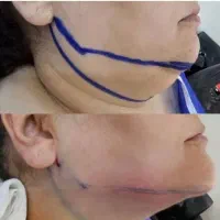 ساکشن غبغب و کانتورینگ