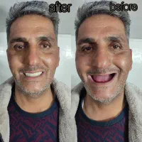 دندان مصنوعی