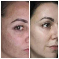 مراقبت پوست|آرایشی، بهداشتی، درمانی|تهران, جی|دیوار