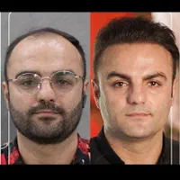 کاشت مو و ابرو در میانه