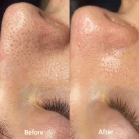 پاکسازی وفیشال پوست|خدمات آرایشگری و زیبایی|قم, صدوق|دیوار
