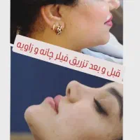 تزریق فیلر و بوتاکس ساکشن غبغب و بوکال فت