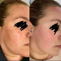 کرم نقره سفیدکننده درمان منافذولک دقیق بخون