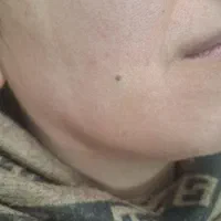 برداشتن انواع خال گوشتی و زگیل ومیکرونیدلینگ|خدمات آرایشگری و زیبایی|قم, انصار‌الحسین|دیوار