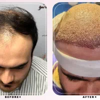 جشنواره کاشت مو رایگان فقط هزینه مواد مصرفی