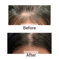 تخفیف ویژه پی آر پی|آرایشی، بهداشتی، درمانی|بهبهان, |دیوار