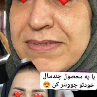 جوانساز بیوممتیک جایگزین مناسب بوتاکس تخصصی