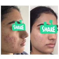 درمان لیزری جوش، آکنه اسکار، آبله، استرچ مارک