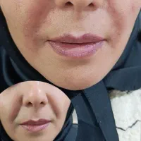 خدمات ژل وبوتاکس