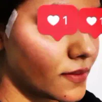 لیپوساکشن چربی جراحی بلفارو لیفت نخ ژل
