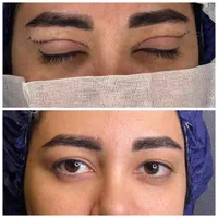 تخفیف عمل پلک و بینی و غبغب و لیپو و ابدو وترانسفر