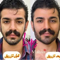 جشنواره پاییزه فیلر لب ژللب بوتاکس زاویه فک گونه|خدمات آرایشگری و زیبایی|کرج, مطهری|دیوار