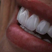 کامپوزیت دندان لمینت روکش طلا اقساط