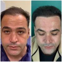 کاشت مو وابرو وریش(نقد واقساط ) اقساطی