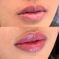 تزریق ژل و بوتاکس‌آموزش(۶ ت بامدرک)درکلینیک‌|خدمات آرایشگری و زیبایی|خرم‌آباد, |دیوار
