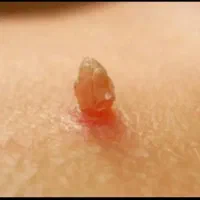رفع hpv|آرایشی، بهداشتی، درمانی|لاهیجان, شیشه گران|دیوار
