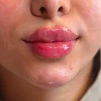 تخفیف خاص لیپوساکشن فیلر بوتاکس