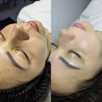 فیشیال،پلاژن تراپی برای بانوان و آقایان درمطب پزشک|خدمات آرایشگری و زیبایی|شیراز, قدوسی غربی|دیوار