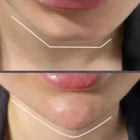 خدمات ژل بیکینی و زیر چشم و بوتاکس|خدمات آرایشگری و زیبایی|شاهین‌شهر, فردوسی|دیوار