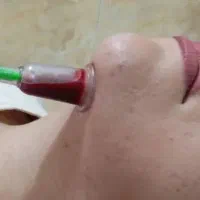 حجامت ،فصدوزالو،سم زدا ویونیزاسیون ماساژ درمانی|خدمات آرایشگری و زیبایی|سنندج, |دیوار