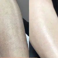 لیزر فقط ‌فقط 690تومان|خدمات آرایشگری و زیبایی|گنبد کاووس, |دیوار