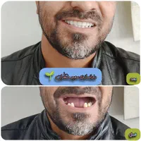 دندان مصنوعی/ ضمانتی / ایتالیایی/ جوان پسند|خدمات آرایشگری و زیبایی|مشهد, امام رضا (ع)|دیوار