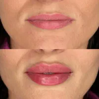 فیلرلب مادلینگ جوانسازی بوتاکس فیلرزیرچشم فیلربادی|خدمات آرایشگری و زیبایی|تهران, سید خندان (جلفا)|دیوار