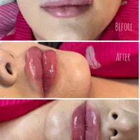 تزریق ژلو فیلر به مدت محدوود۹۹۰تومن