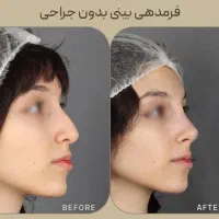 آف ۵۵٪ فیلربادی ژل بینی ابرو باسن سینه غبغب بیکینی|خدمات زیبایی و سلامت|مشهد, هفت تیر (آب و برق)|دیوار
