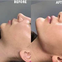 پی ارپی بوتاکس چانه هایفوفیلر لب چانه گونه لیفت نخ