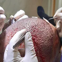 کاشت تخصصی مو و ریش،مزوتراپی،prp(تضمینی)