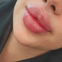 تزریق ژل و بوتاکس