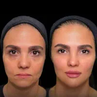 تزریق بوتاکس درمنزل سراسر شیراز