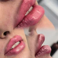 ژل و فیلر  بوتاکس لیفت با نخ پی ارپی  یوسفی