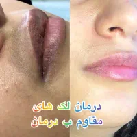 کاموفلاژ رفع تیرگی قطعی زیرچشم و لک|خدمات آرایشگری و زیبایی|تهران, شکوفه (عبدل آباد)|دیوار