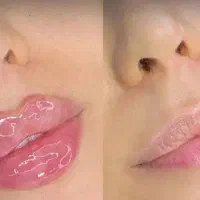 تزریق تخصصی انواع ژل،بوتاکس،پرسینگ،آنزیم،لیزر