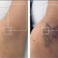لیزر موهای زائد/ریمو تتو/لاغری/ژل/بوتاکس|خدمات آرایشگری و زیبایی|تهران, سعادت‌آباد|دیوار