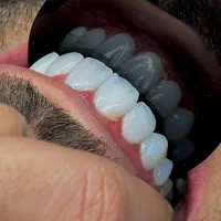 دندانپزشکی کشیدن کامپوزیت عصب کشی پرکردن ترمیم|خدمات زیبایی و سلامت|تهران, افسریه شمالی|دیوار