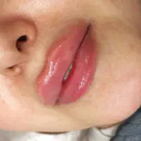 جشنواره بوتاکس و ژل دستگاه جوانساز(هایفو،اندولیفت)|خدمات زیبایی و سلامت|تهران, نیلوفر|دیوار
