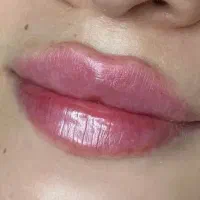 مادلینگ صورت باپک ده سی سی فقط 8/900 فیلربوتاکس ژل