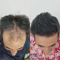 رویش مجدد مو تضمینی و قسطی|آرایشی، بهداشتی، درمانی|رشت, بلوار گیلان|دیوار