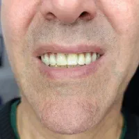 دندان مصنوعی اقساطی