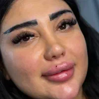 اف ۵۰٪ به مدت یک هفته فیلر و بوتاکس ۱ تومن