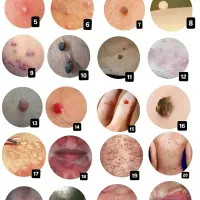 تبخال و زگیل تناسلی