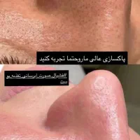 خدمات فیشال و پاکسازی پوست