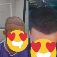 انجام خدمات کاشت مو به روش میکرو fit